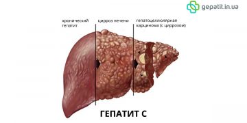 Вирусный гепатит В у взрослых: пути передачи, симптомы, лечение, профилактика в домашних условиях